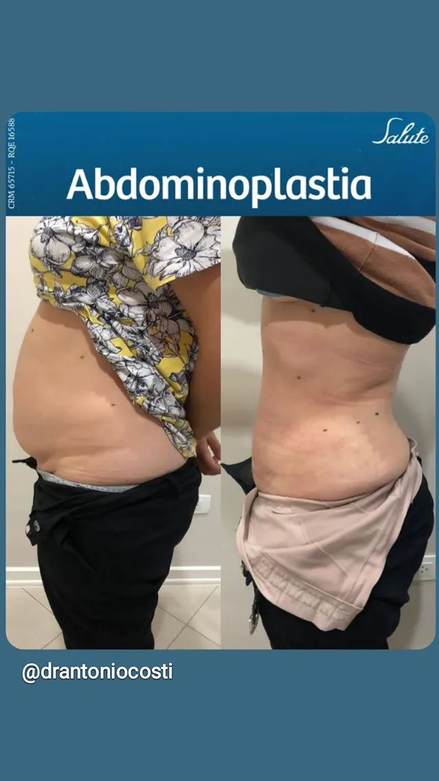 Abdominoplastia — resultado antes e depois, cirurgia com Dr. Antônio Costi