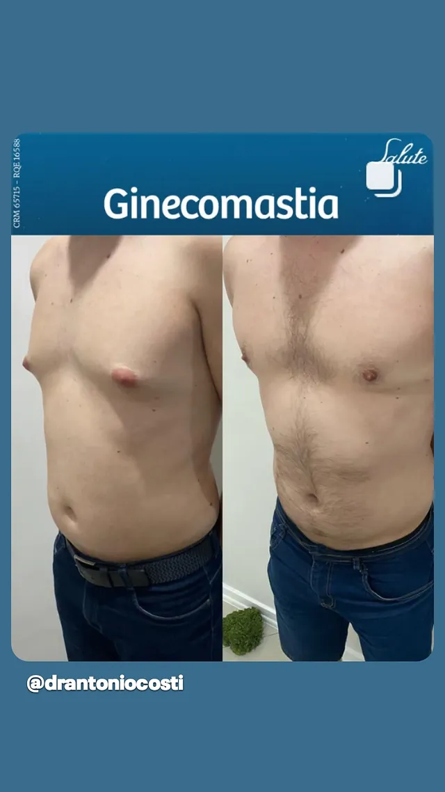 Ginecomastia — resultado antes e depois, cirurgia com Dr. Antônio Costi
