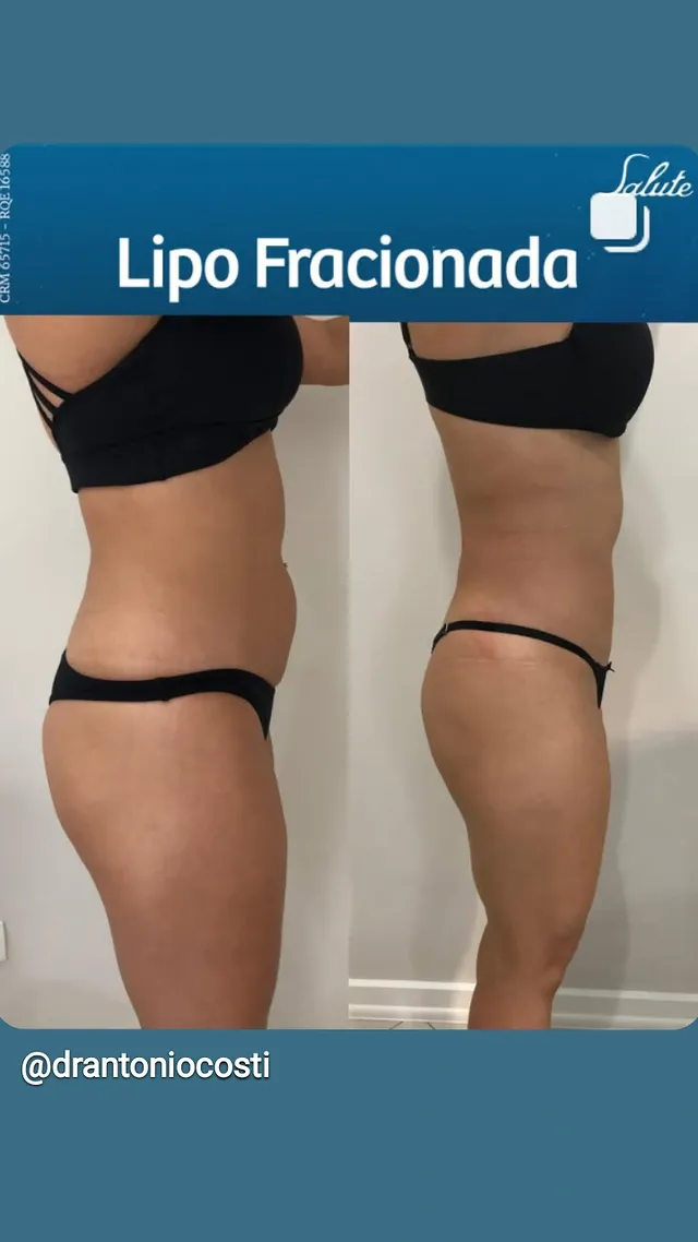 Lipo fracionada — resultado antes e depois, cirurgia com Dr. Antônio Costi
