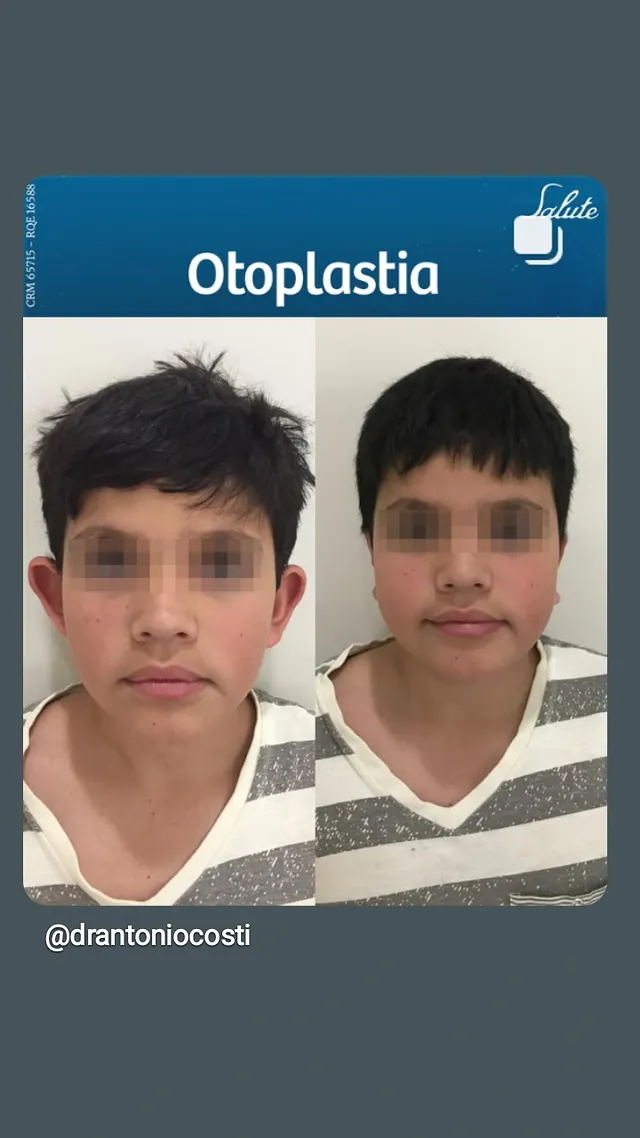 Otoplastia · caso 2 — resultado antes e depois, cirurgia com Dr. Antônio Costi