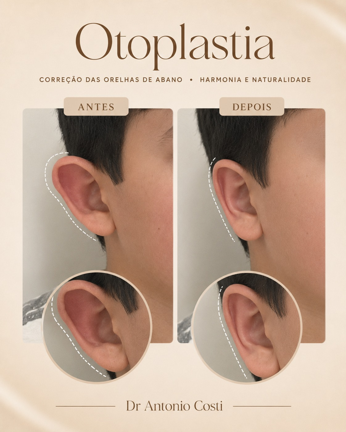 Otoplastia · caso 1 — resultado antes e depois, cirurgia com Dr. Antônio Costi