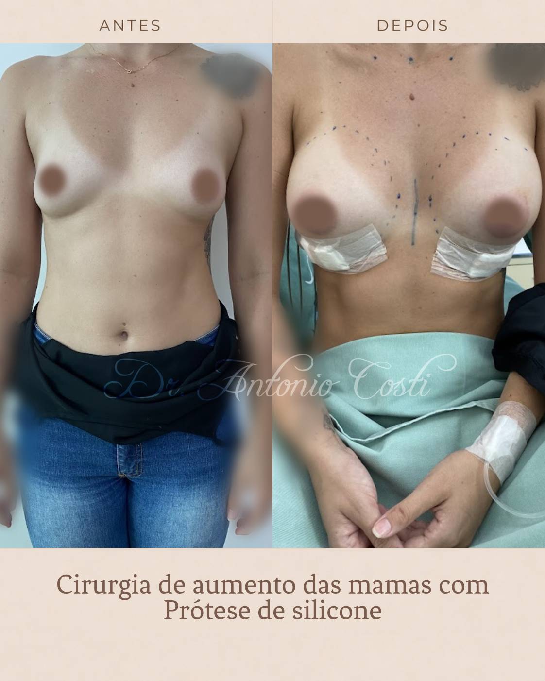 Cirurgia das mamas · caso 1 — resultado antes e depois, cirurgia com Dr. Antônio Costi