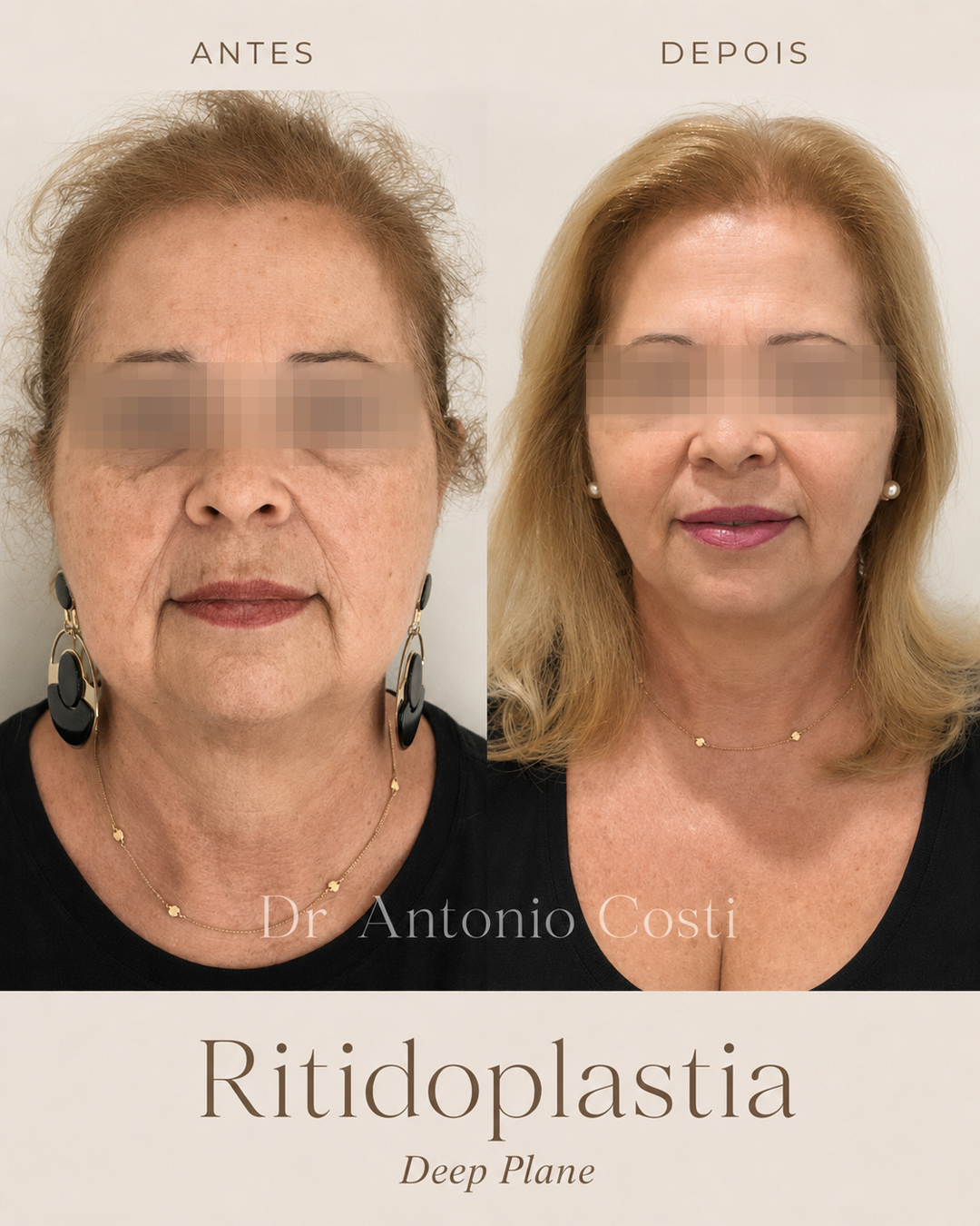 Ritidoplastia deep plane · caso 1 — resultado antes e depois, cirurgia com Dr. Antônio Costi
