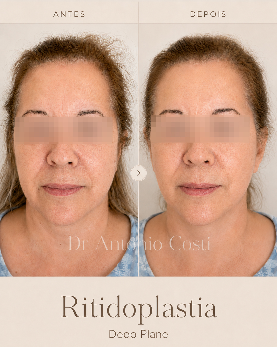 Ritidoplastia deep plane · caso 2 — resultado antes e depois, cirurgia com Dr. Antônio Costi