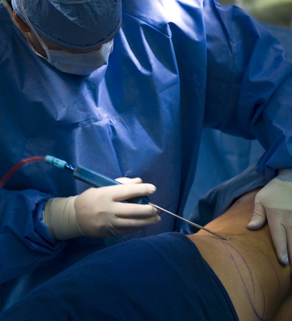 Liposuction
